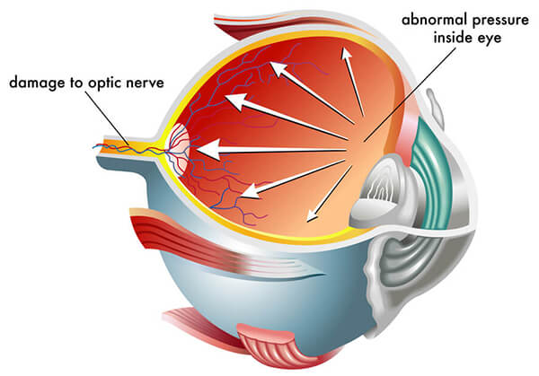 Chart Showing How Glaucoma Affects the Eye With Pressure
