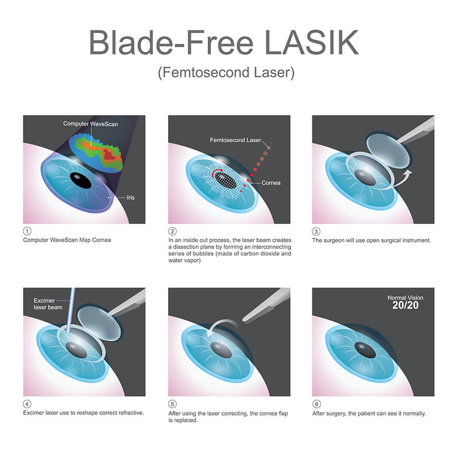 Chart Showing the Blade-Free LASIK Method
