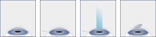 Chart Showing the Steps of LASIK