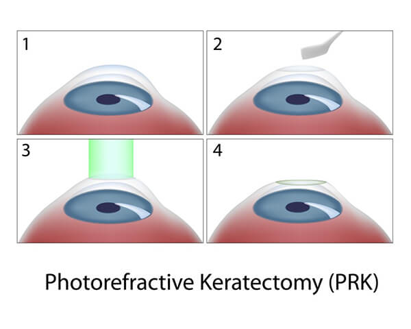 Chart Showing the PRK Process